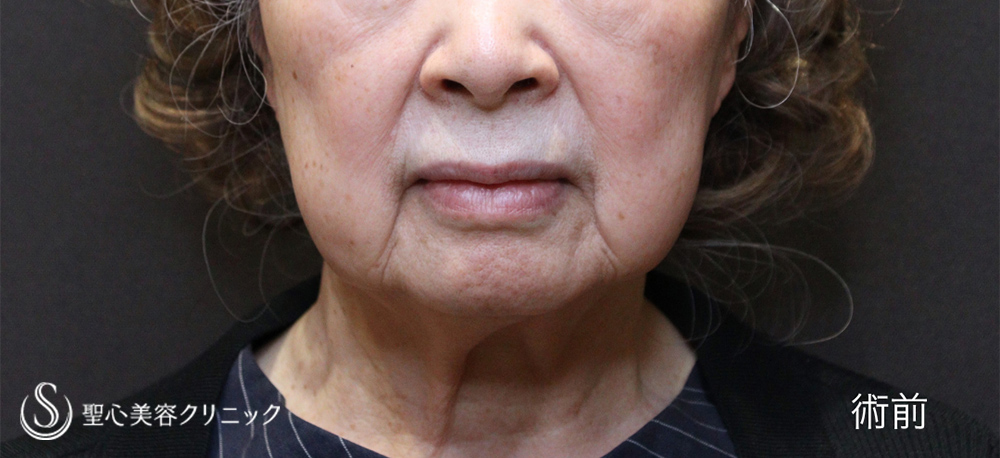 フェイスリフト_Before