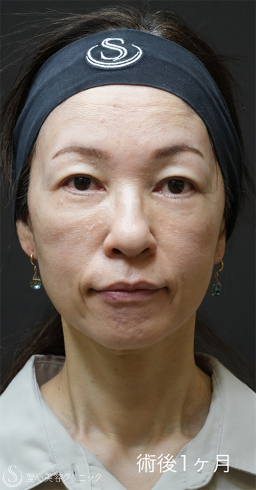 下眼瞼切開術/下眼瞼除皺術/ハムラ法＋ミッドチークリフト_After