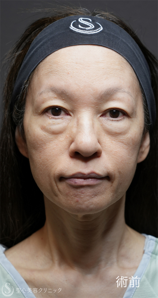 下眼瞼切開術/下眼瞼除皺術/ハムラ法＋ミッドチークリフト_Before