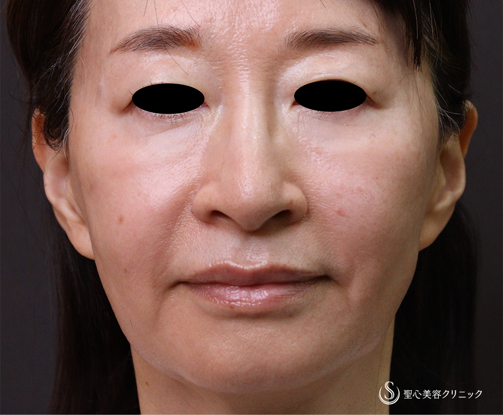 プレミアムPRP皮膚再生療法_After