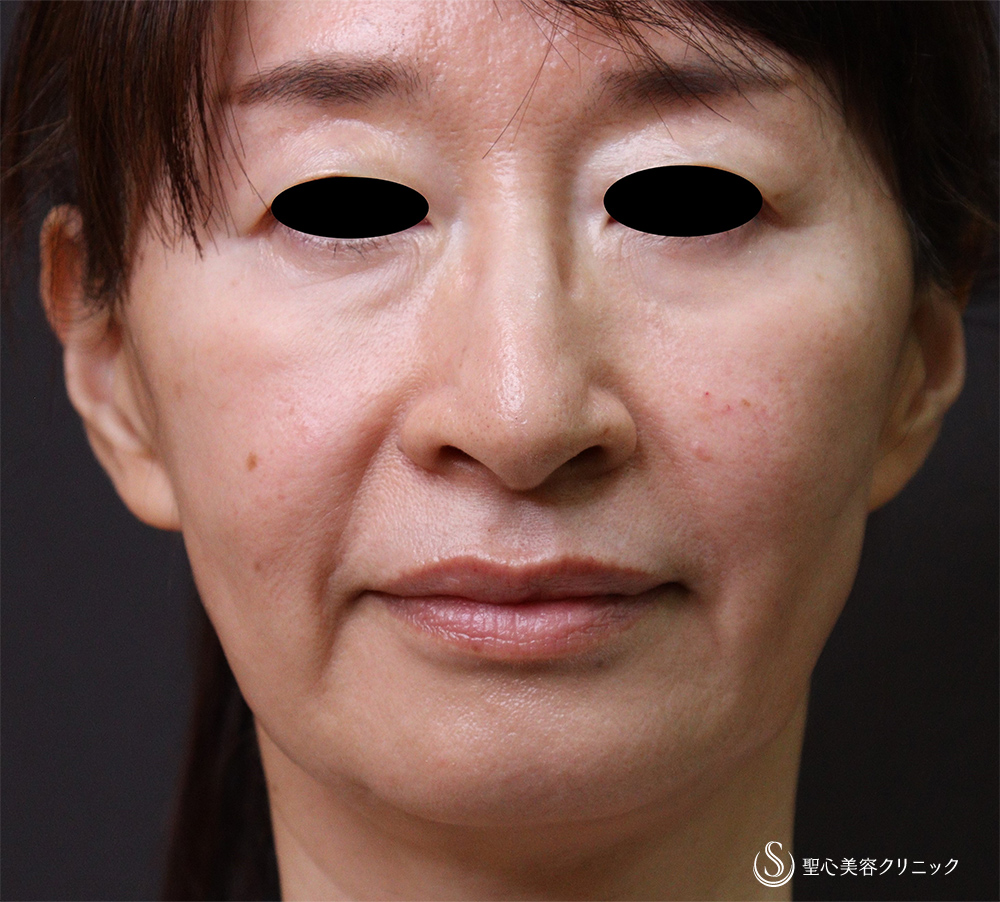 プレミアムPRP皮膚再生療法_Before