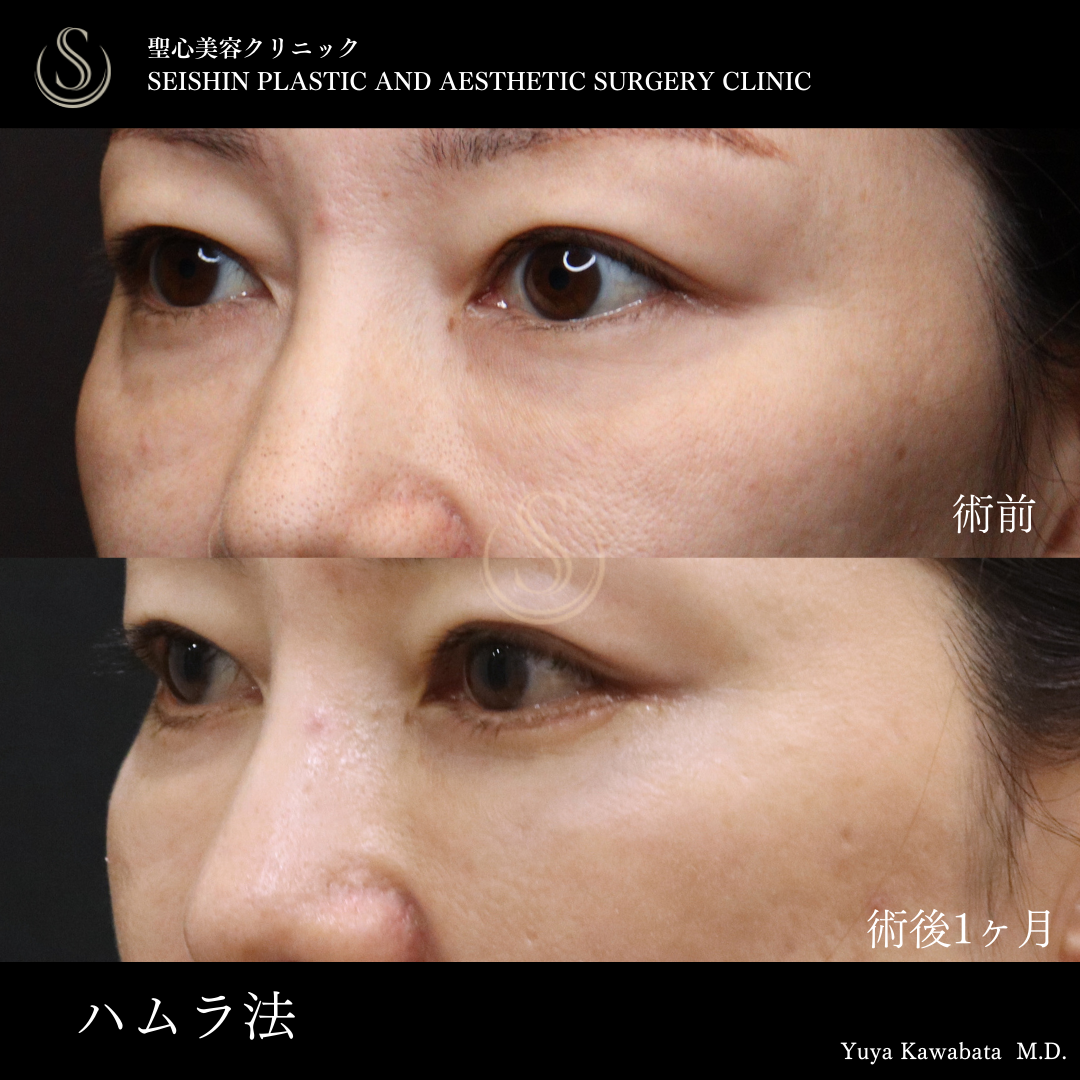 下眼瞼切開術/下眼瞼除皺術/ハムラ法_After