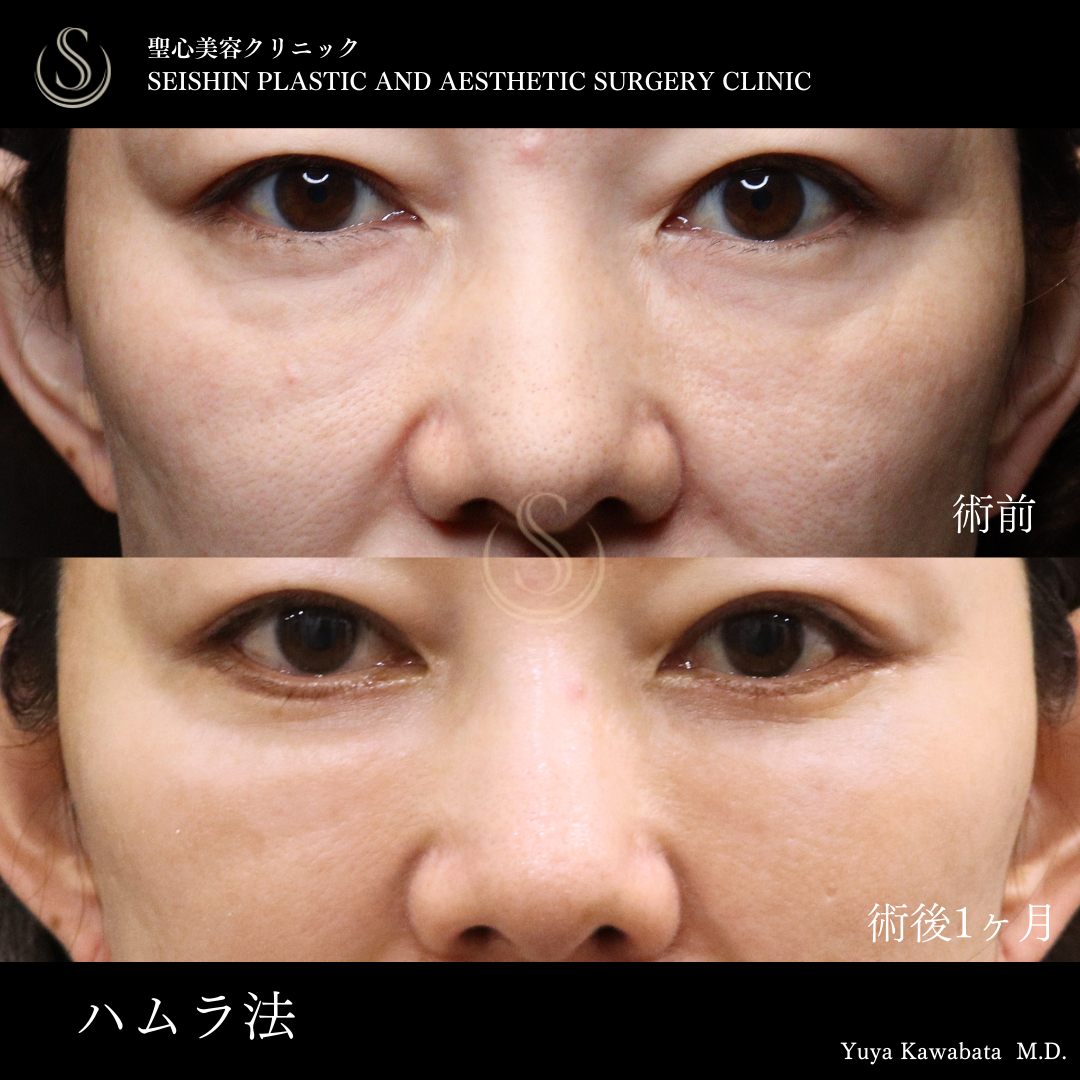 下眼瞼切開術/下眼瞼除皺術/ハムラ法_Before