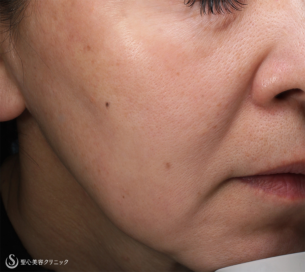 ルビーフラクショナルレーザー_After