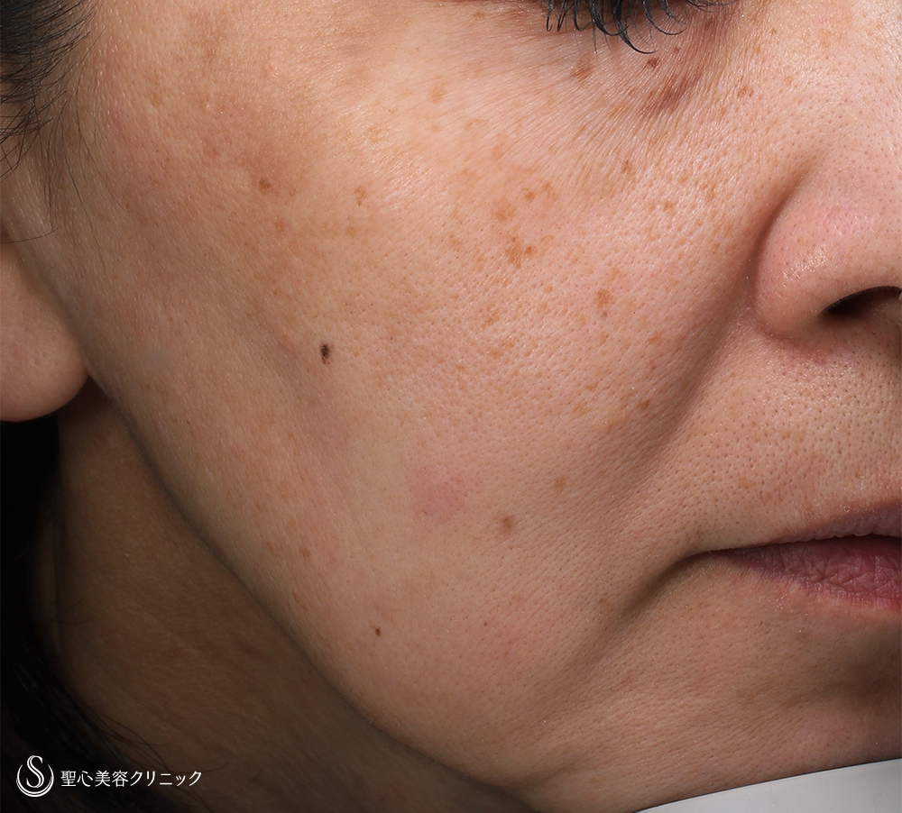 ルビーフラクショナルレーザー_Before