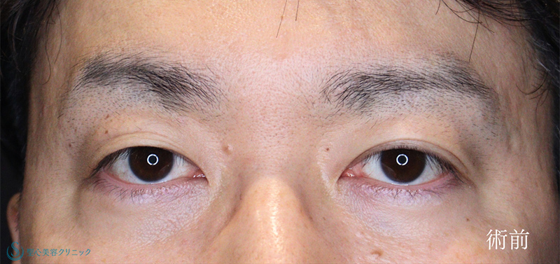 眼瞼下垂（切開法/腱膜縫縮法）_Before