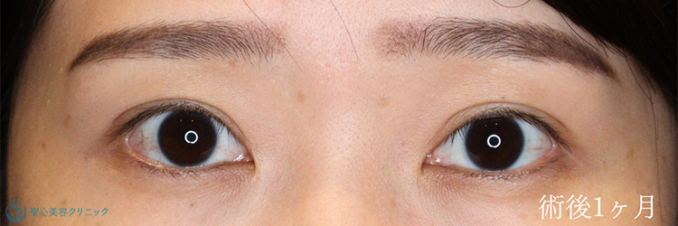 二重術（埋没法）：マイクロメソッド+α_After