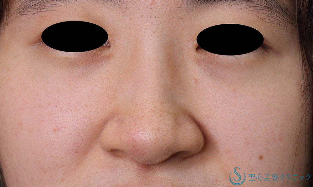 鼻尖縮小＋小鼻縮小_Before
