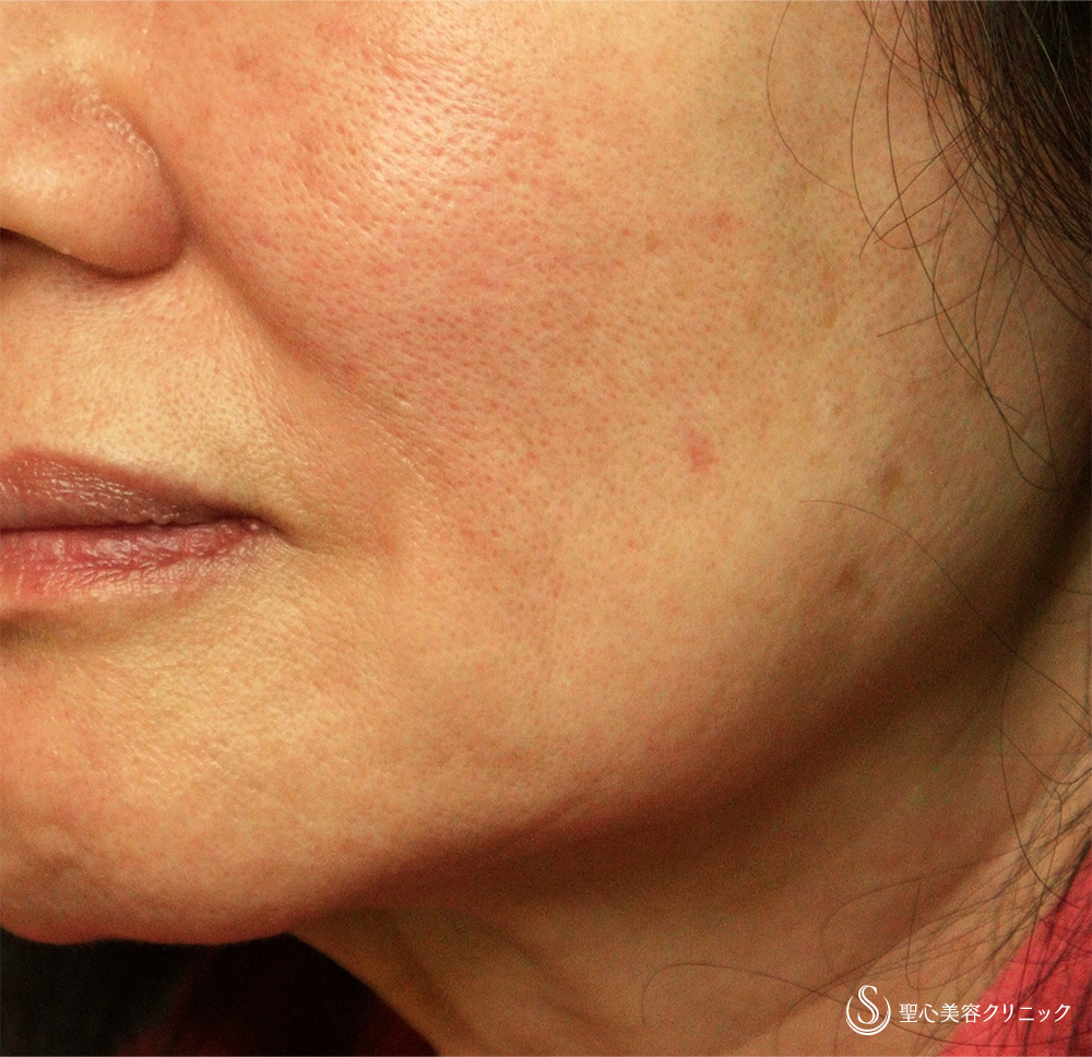 プレミアムPRP皮膚再生療法_After
