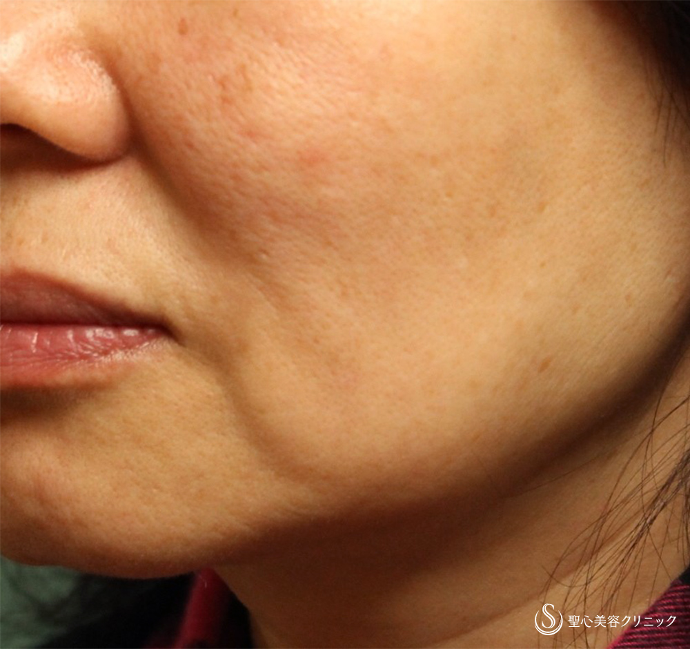 プレミアムPRP皮膚再生療法_Before