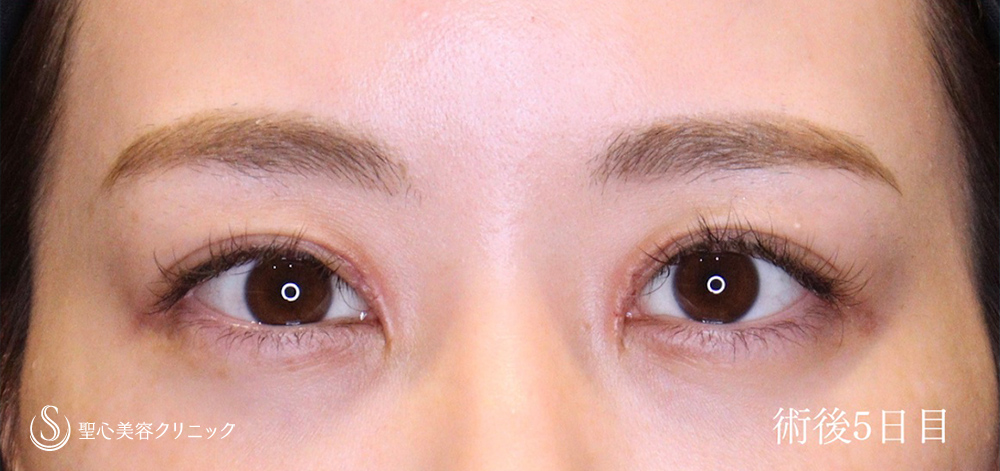 目上切開_After