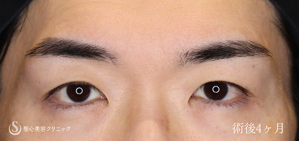  眼瞼下垂（切開法/腱膜縫縮法）_After