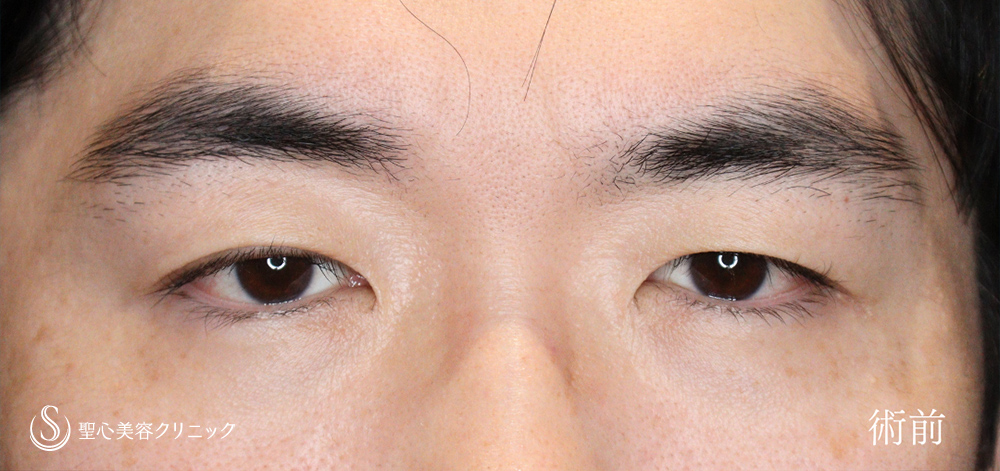  眼瞼下垂（切開法/腱膜縫縮法）_Before