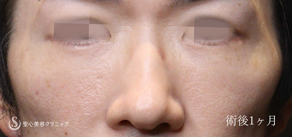 ハムラ法（脂肪移動＋たるみ除去）_After