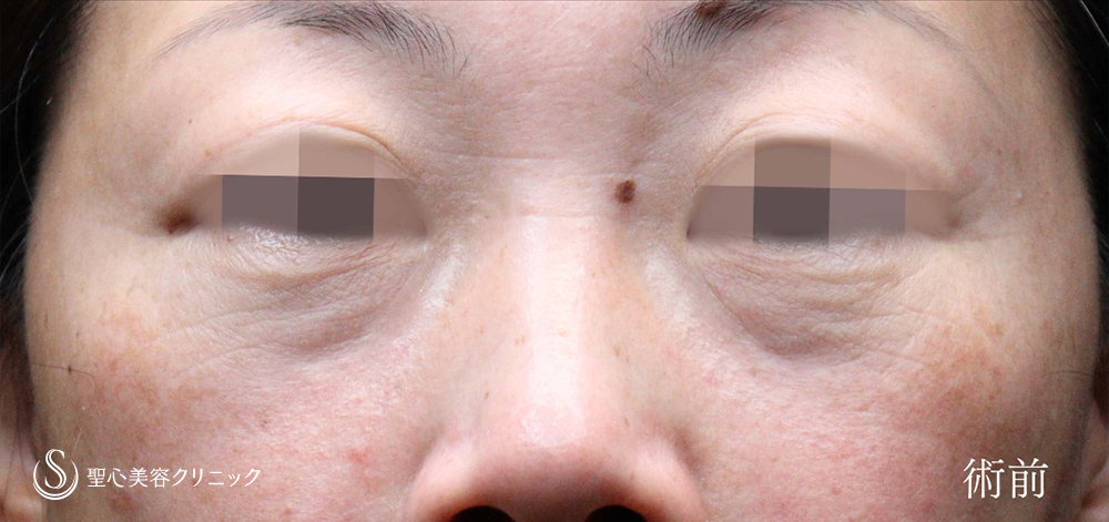 プレミアムPRP皮膚再生療法_Before