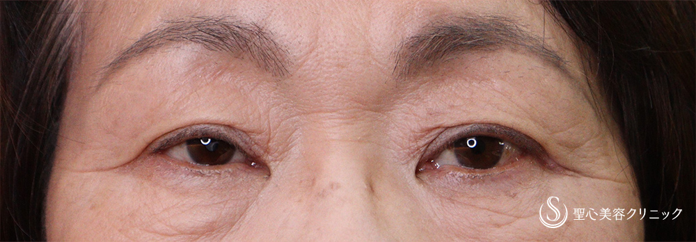 眼瞼下垂（埋没法）_After