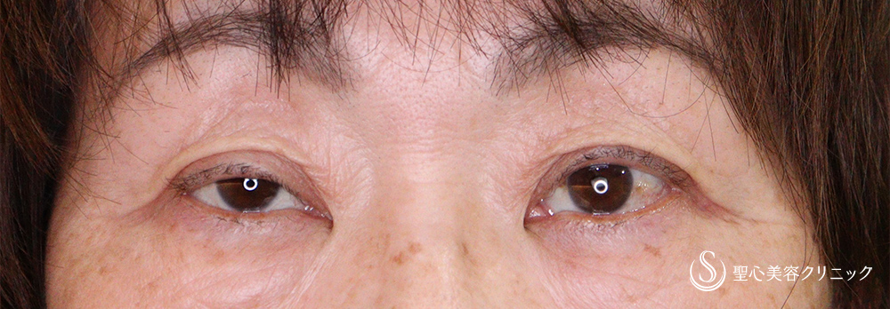 眼瞼下垂（埋没法）_Before