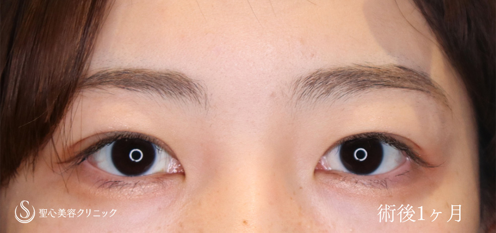 マイクロメソッド+α（二重埋没法）α_After