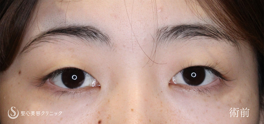 マイクロメソッド+α（二重埋没法）_Before