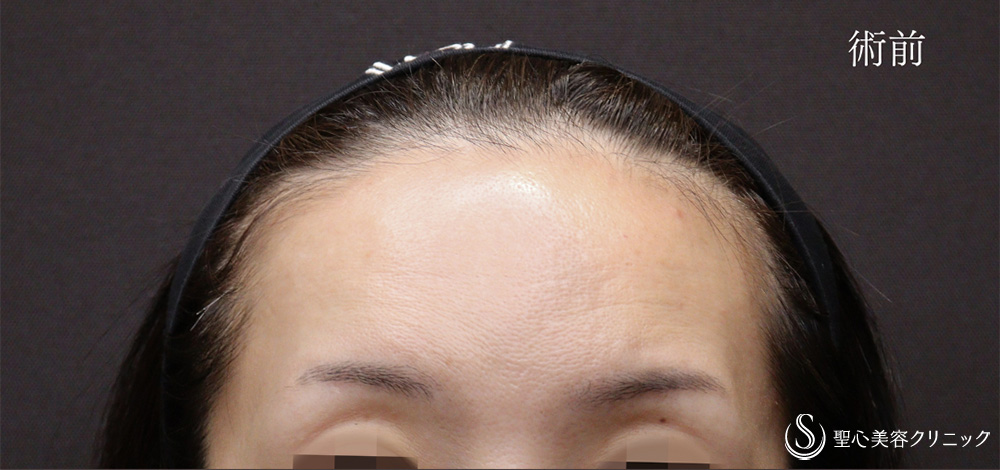 プレミアムPRP皮膚再生療法_Before