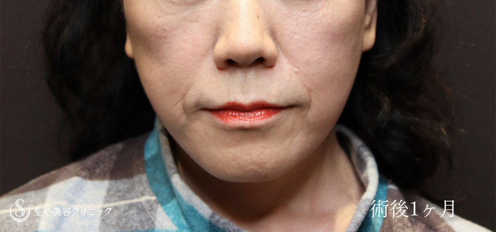 フェイスリフト＋ 脂肪吸引注射（頬＋顎下）_After