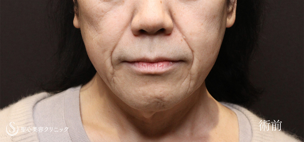 フェイスリフト＋ 脂肪吸引注射（頬＋顎下）_Before