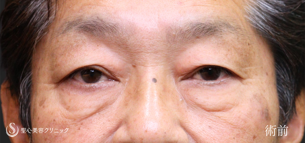 ハムラ法＋眉下切開法（眉下リフト）_Before