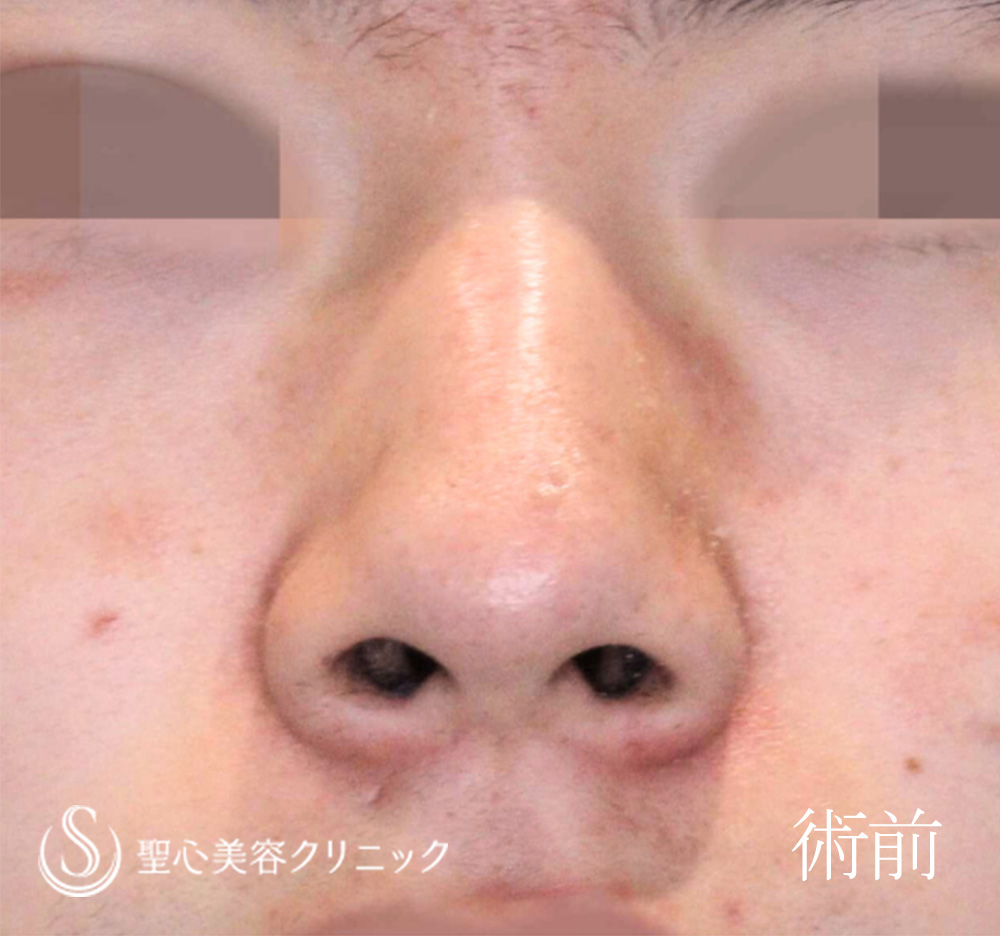 鼻尖形成（耳介軟骨移植）＋鼻尖縮小_Before