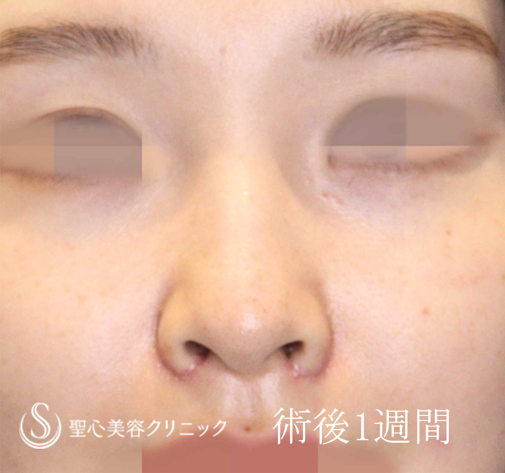 小鼻縮小_After