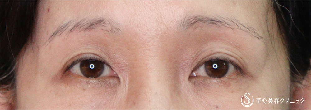 眉下切開法（眉下リフト）_After