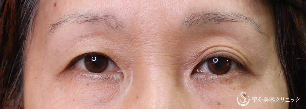 眉下切開法（眉下リフト）_Before