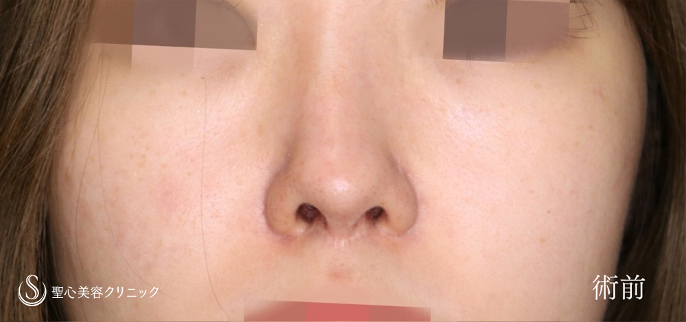 鼻孔縁下降術_Before