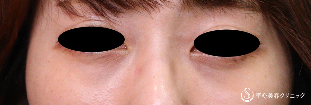 目の下の脂肪取り（経結膜下脱脂法）_After