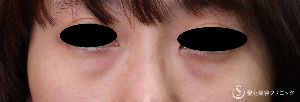 目の下の脂肪取り（経結膜下脱脂法）_Before